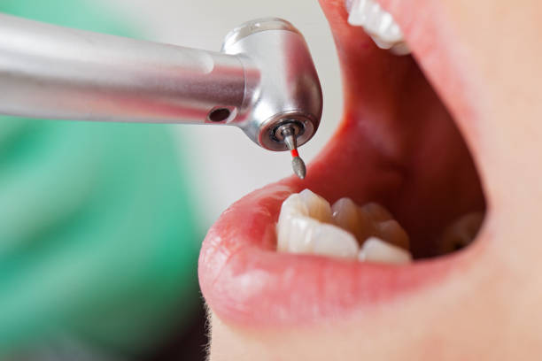 Best Emergency Tooth Extraction  in Eslon, CA